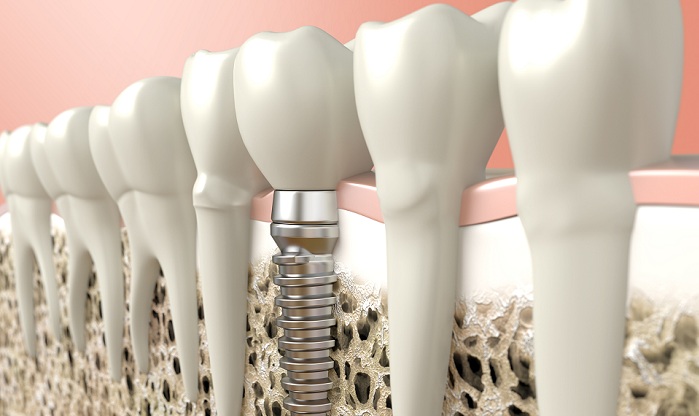 Dental implant san antonio