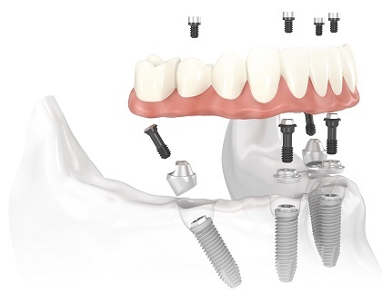 All-on-4, all on four dental implants san antonio dentist