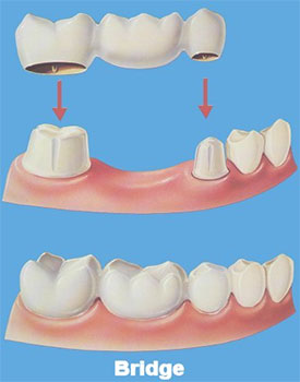 Dental Crown San Antonio