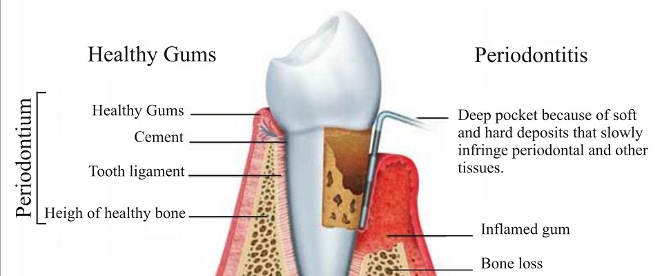 Periodontal Disease San Antonio dentist