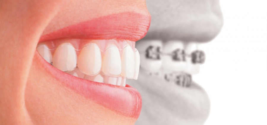 braces and orthodontics in San Antonio Dr. Parsi