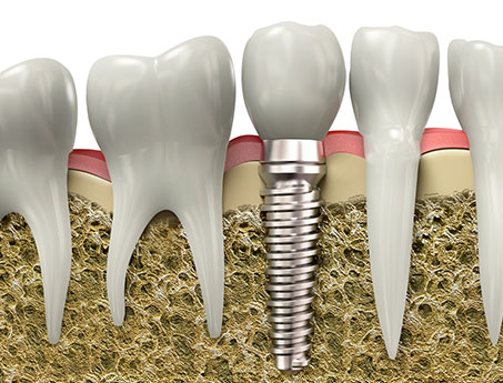 Dental Implant San Antonio