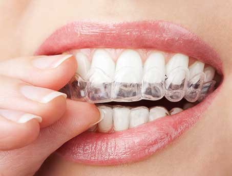 Braces, Orthodontic Treatment, Invisalign San Antonio