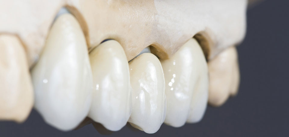 Dental Crowns San Antonio