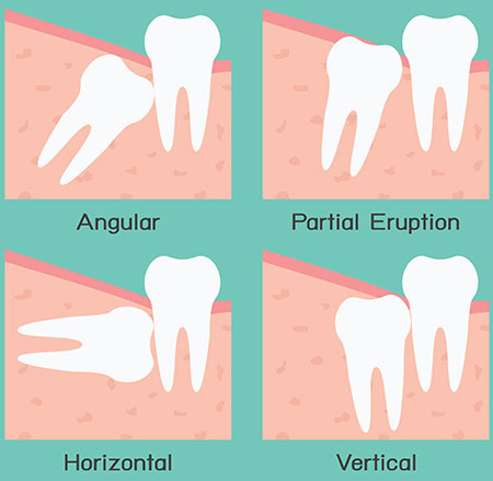 Wisdom Teeth Extraction San Antonio